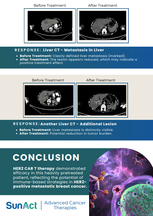 SunAct breast cancer case study showcasing HER2-positive treatment with CAR T-cell therapy