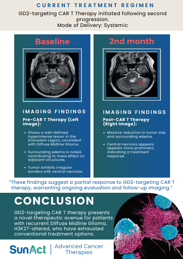 SunAct case study on GD2-targeted CAR T therapy for diffuse midline glioma in a 22-year-old male