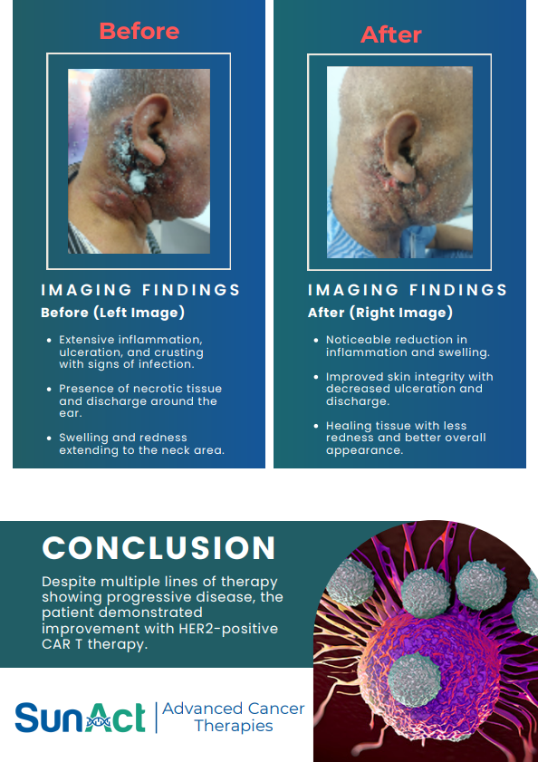 SunAct head and neck cancer case study on salivary ductal carcinoma managed with advanced therapies