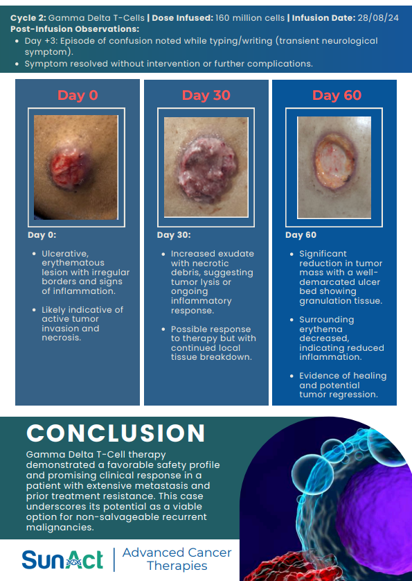 SunAct case study featuring gamma delta T-cell therapy for recurrent tongue carcinoma with extensive metastasis