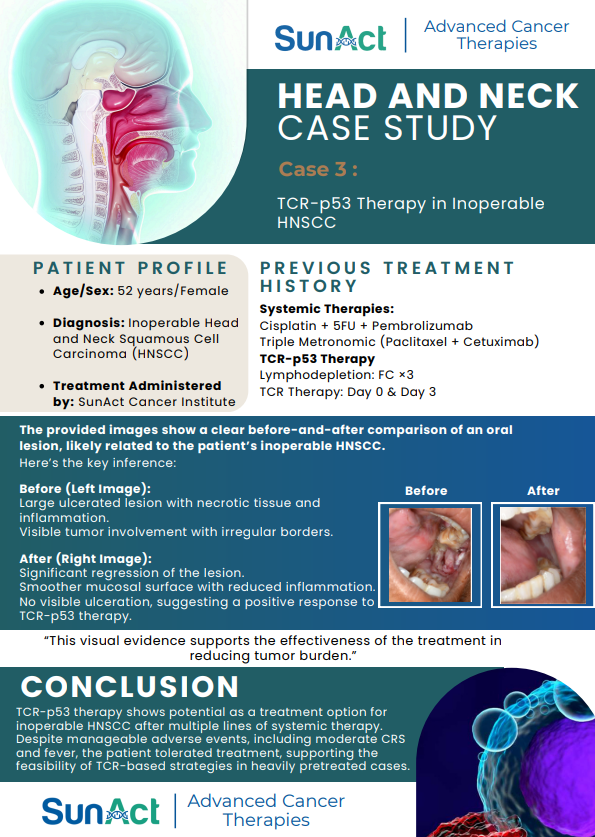 SunAct head and neck cancer case study using TCR-p53 therapy in inoperable squamous cell carcinoma