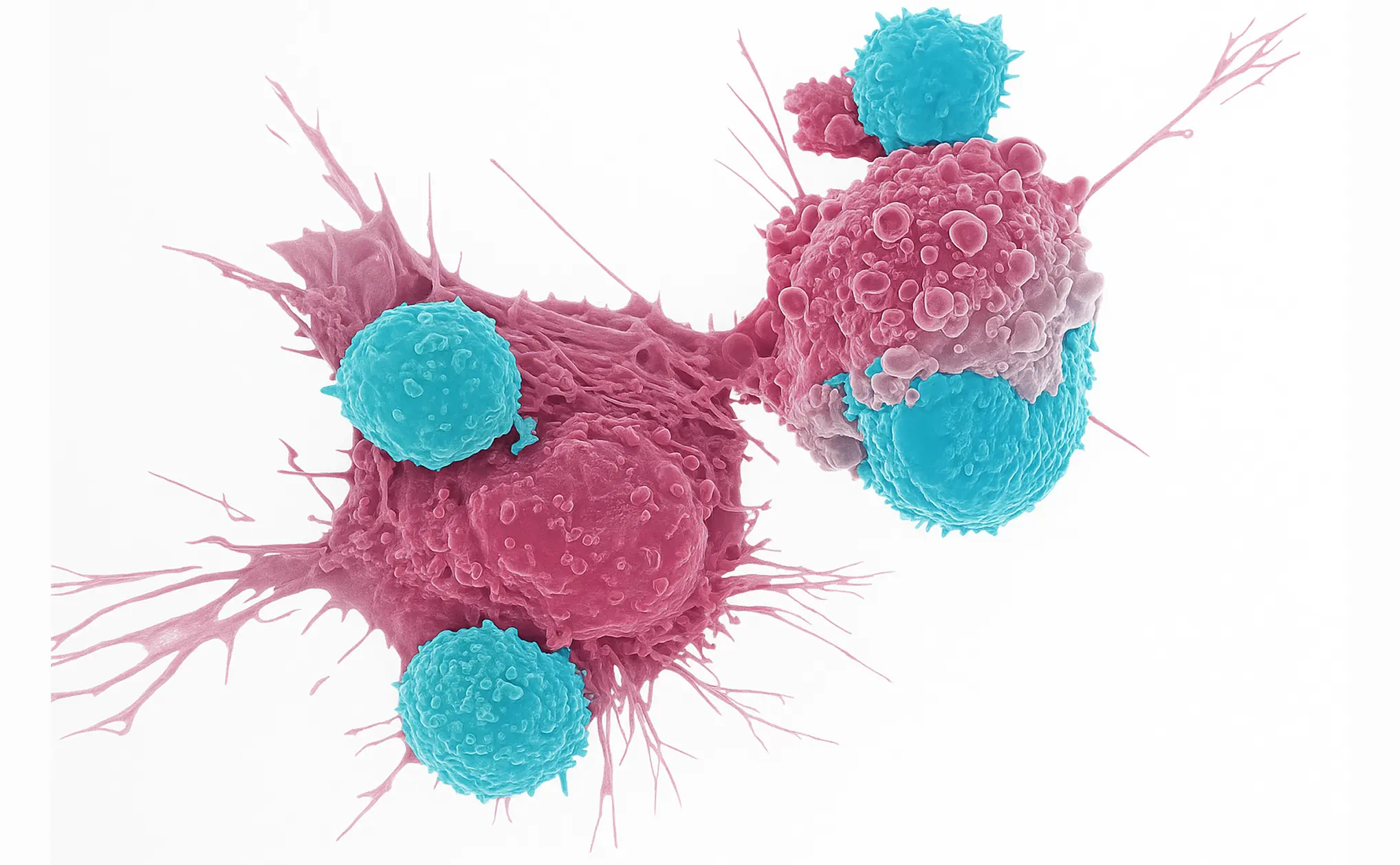 Modified CAR T-cells targeting autoimmune platelets in immune thrombocytopenia (ITP) concept of immune reset therapy